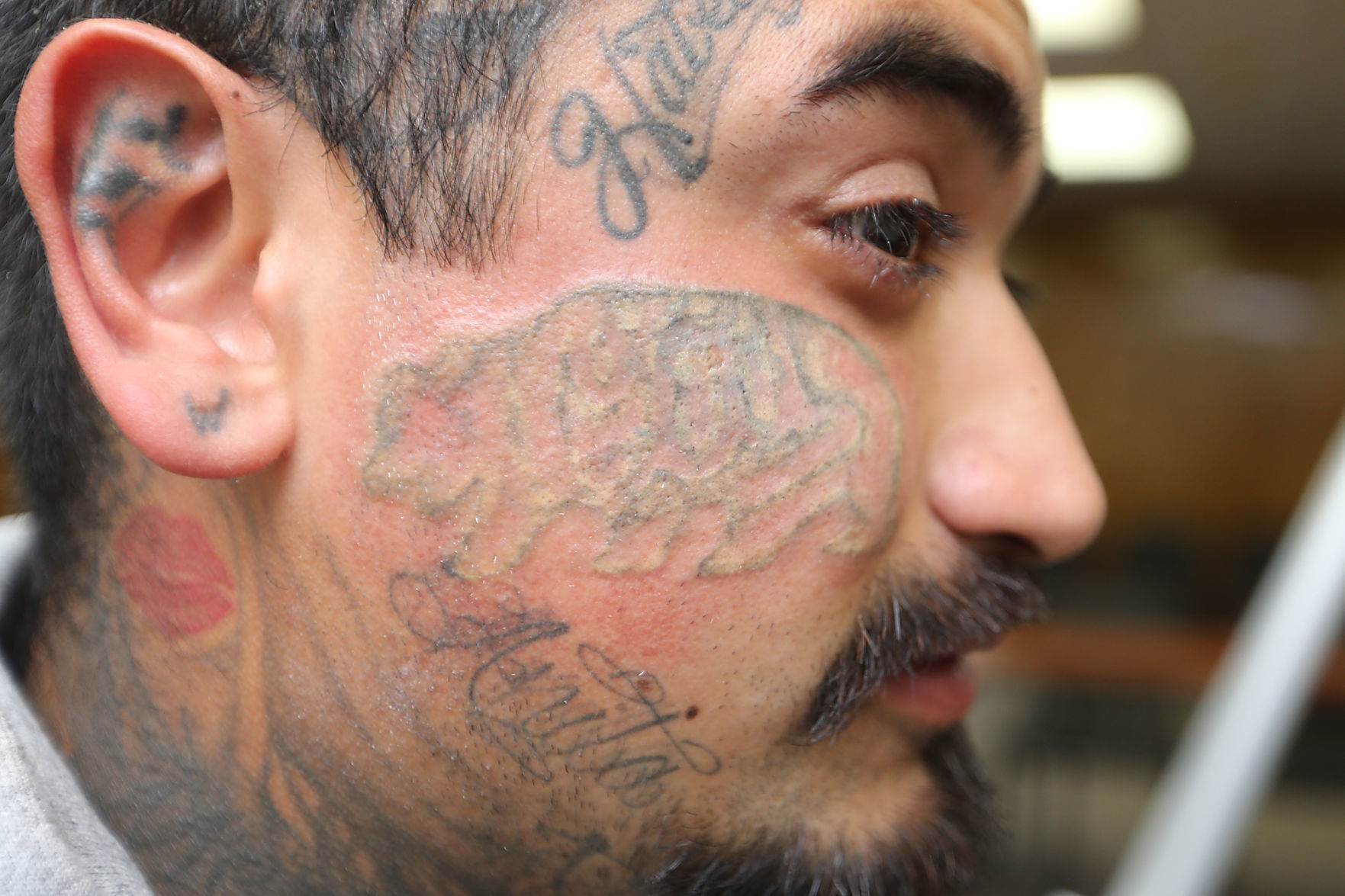 Tattoo Removal